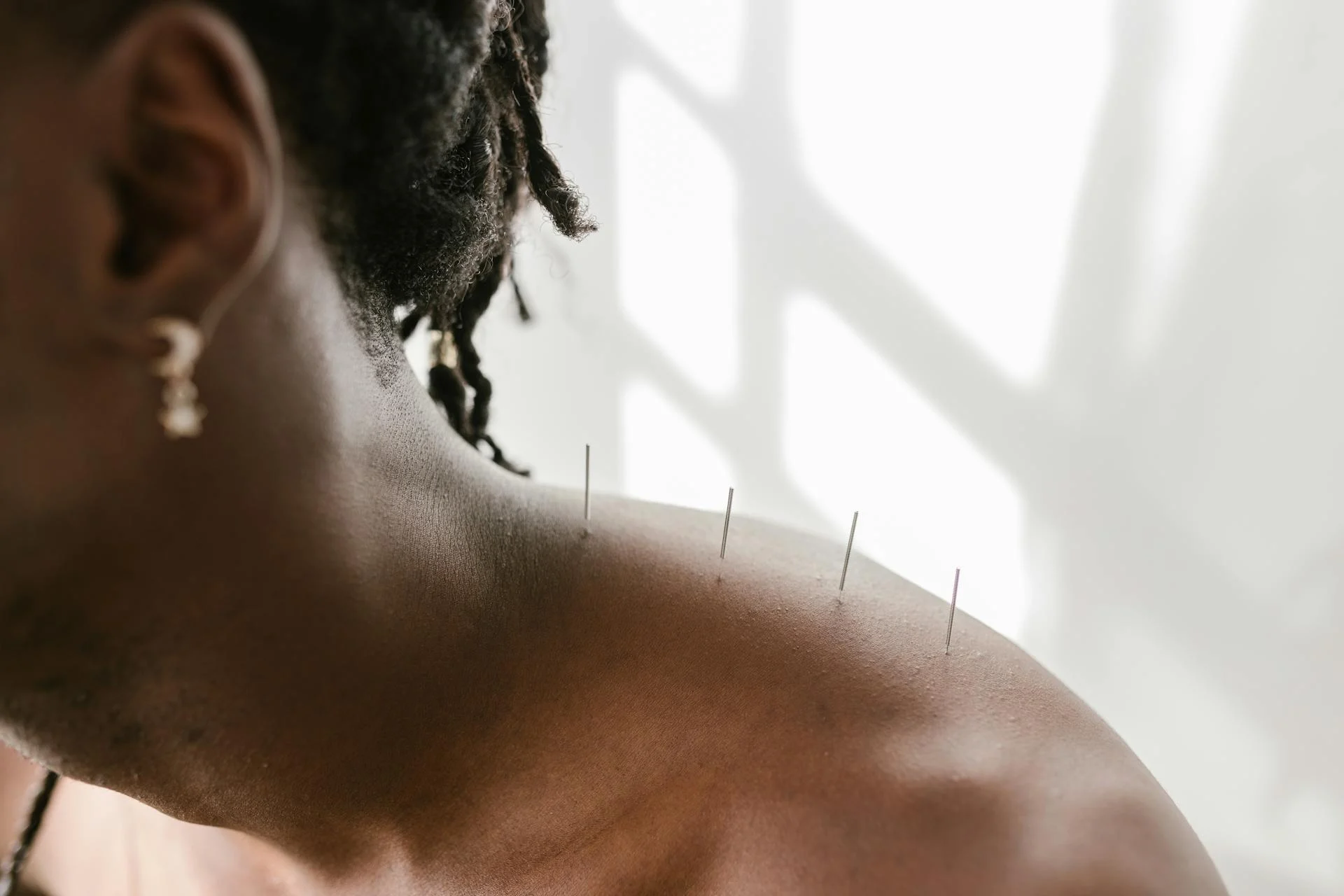 Woman with acupuncture needles.