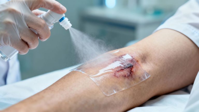 Spray-on skin technology applied to a burn wound.